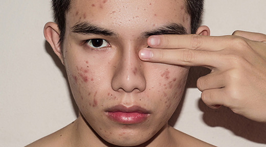 Man with acne scars